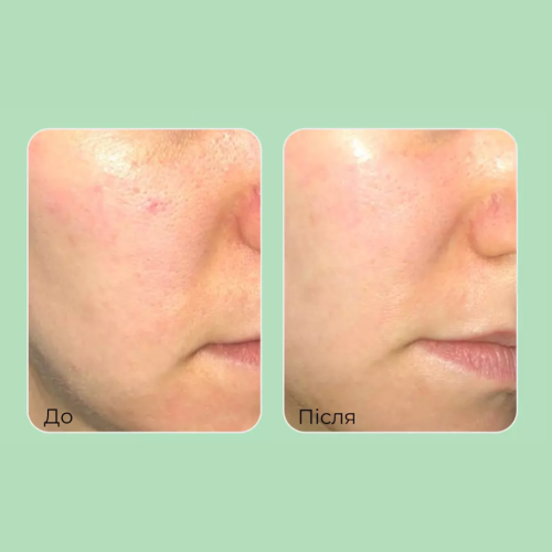 Сироватка заспокійлива з чайним деревом Medi-Peel Dutch Tea A.C Calming Serum 70 ml